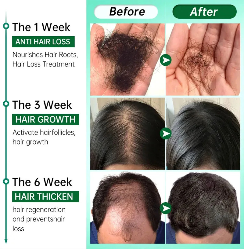 7 Day Fast Hair Growth Serum G - đánh giá và giá Hair Care Essential Oil Atomizing